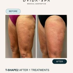 DVida Med Spa - Cellulite issues