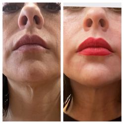 MD Beauty Spa - The picture on the right is only 24 hrs after the Morpheus8 procedure