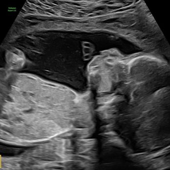 Greggory DeVore Fetal Diagnostic Center - 24 week ultrasound - Diagnostic Services Near Me - Pasadena, California Greggory DeVore Fetal Diagnostic Center - 24 week ultrasound - Diagnostic Services Near Me - Pasadena, California