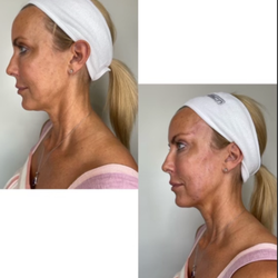 Beverly Hills Rejuvenation Center - PDO Threads