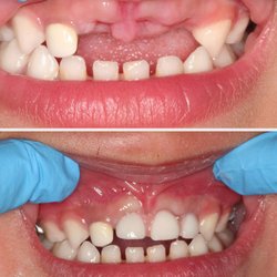 Smile Angels of Beverly Hills - Bruce Vafa DDS. - Baby partial prosthesis