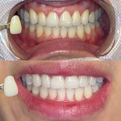 Fairywhite Teeth Whitening - Teeth whitening Results in 60 minutes