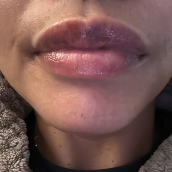 V & Co - A few days after my first initial appt. - Skin Care Near Me - San Jose, California V & Co - A few days after my first initial appt. - Skin Care Near Me - San Jose, California