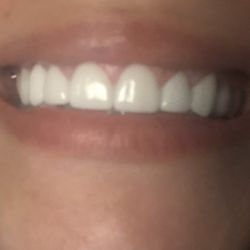 My Dentist West Mount - Dental bridge