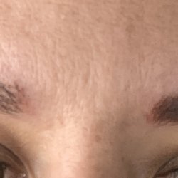 Impressions Skin Solutions - Eyebrows after first laser session 9/1/22