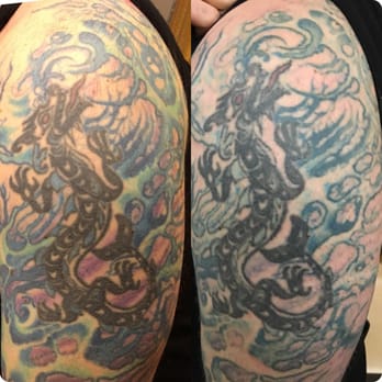 Hindsight Tattoo Removal - One treatment with the Picosure laser system. Check out picosure.com for more information. - Tattoo Removal Near Me - Chicago, Illinois Hindsight Tattoo Removal - One treatment with the Picosure laser system. Check out picosure.com for more information. - Tattoo Removal Near Me - Chicago, Illinois