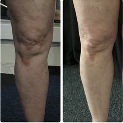 Pure Laser Skin Care - One session with our ULTRA THERAPY
Look at the tightness and tone of the knee and the shape has already changed in 4 weeks