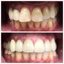 Reflection Dental San Juan Capistrano - Patient came in to see Dr. Akhavan because she was very unhappy with her smile. Dr. Akhavan was able to transformed her smile using veneers.
