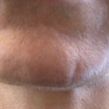 Alchemy 43 - Flatiron - Another photo of the HUGE indent they left on my chin. Don't ever go here!!!!! They won't even take accountability. - Medical Spas Near Me - New York, New York