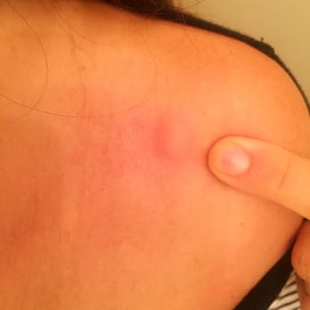 Motel 6 - Bed Bug Bite moments from when I was awoken from my sleep! - Hotels Near Me - Winslow, Arizona