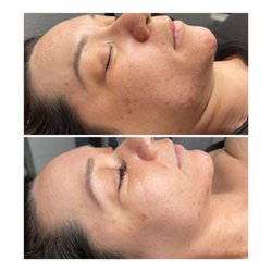 The Touch - Microneedling Before and After 3 sessions