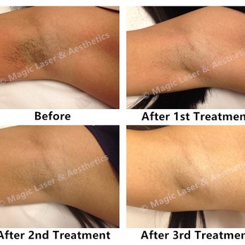 Magic Laser and Aesthetics - Laser Hair Removal for underarms. - Laser Hair Removal Near Me - Toronto, Ontario