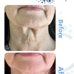 Marjohn SkinCare - C.Oxy facial