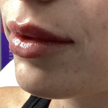 All Natural Aesthetics - Lip filler - Medical Spas Near Me - Las Cruces, New Mexico All Natural Aesthetics - Lip filler - Medical Spas Near Me - Las Cruces, New Mexico