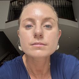 Salmon DNA microneedling treatment. Salmon DNA microneedling treatment.