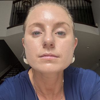 Troiareuke Lake Forest - Salmon DNA microneedling treatment. - Skin Care Near Me - Lake Forest, California Troiareuke Lake Forest - Salmon DNA microneedling treatment. - Skin Care Near Me - Lake Forest, California