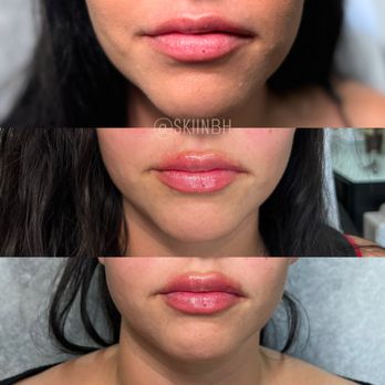 Skiin Blackhawk - This is your sign to book your lip filler appt - Medical Spas Near Me - Danville, California