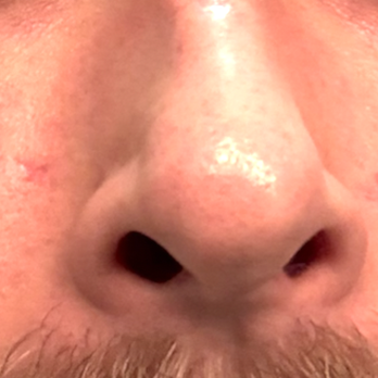 Botoxie - A month after I was treated - Medical Spas Near Me - San Diego, California Botoxie - A month after I was treated - Medical Spas Near Me - San Diego, California