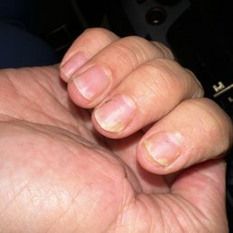 Fungus and thin nails