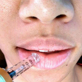 Athena Beauty Bar - Hyolornpen Instant Plump Needles Lip Fillers - Permanent Makeup Near Me - Allen, Texas Athena Beauty Bar - Hyolornpen Instant Plump Needles Lip Fillers - Permanent Makeup Near Me - Allen, Texas