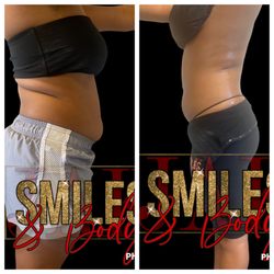 Jak Smiles - Laser lipo