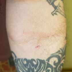 American Red Cross - Next day after platelet donation. Just had a tiny bit of bleeding, but that can happen.