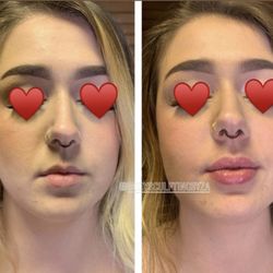 Body Sculpting by Za - Needle-less filler