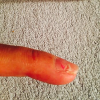 Belle Image Salon - Update on my nail injury. 9days later. My Nail torn off - Hair Salons Near Me - Chula Vista, California Belle Image Salon - Update on my nail injury. 9days later. My Nail torn off - Hair Salons Near Me - Chula Vista, California