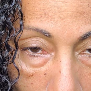 Clear Medical - 3D effect still there. - Laser Hair Removal Near Me - Marina del Rey, California Clear Medical - 3D effect still there. - Laser Hair Removal Near Me - Marina del Rey, California