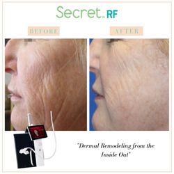 Auveau Medspa - This groundbreaking treatment quickly became a best selling procedure at Skin Savvy! Book yours today
