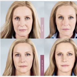 Forever Young Aesthetics - Sculptra - Collagen stimulator