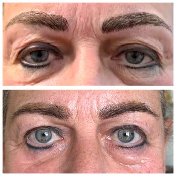 Struktur Studio - 2nd time removing 15-year-old brow & eyeliner tattoos. Ute was precise, caring & affordable--finally getting rid of brows I've hated! - Hair Salons Near Me - Calgary, Alberta