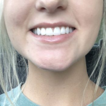 Skinwerx - Before lip flip treatment (top lip) - Medical Spas Near Me - Arlington, Texas Skinwerx - Before lip flip treatment (top lip) - Medical Spas Near Me - Arlington, Texas