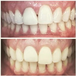 Goodman Orthodontics - Manhattan - This is a nuanced treatment that worked out perfectly. Tooth #8 need a crown replacement. You can see that the gumline was lower.