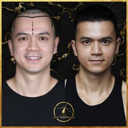 Miami Hair Transplant