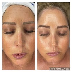 Effortless Beauty Studio - Brightening Facial  before and after.