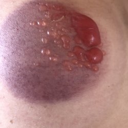 Worst blisters on shoulder