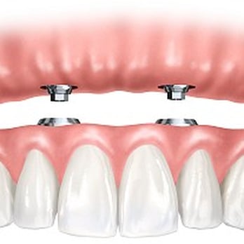 Dental Clinics Antwerpen - Een vastzittende klikgprothese - General Dentistry Near Me - Antwerp, VAN Dental Clinics Antwerpen - Een vastzittende klikgprothese - General Dentistry Near Me - Antwerp, VAN