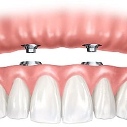 Dental Clinics Antwerpen - Een vastzittende klikgprothese