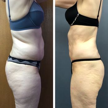 Lite Body Sculpting - AMAZING RESULTS AFTER ONLY 10 TREATMENTS - Weight Loss Centers Near Me - Citrus Heights, California