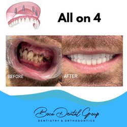 Boca Dental Group - Teeth in 24 hours!