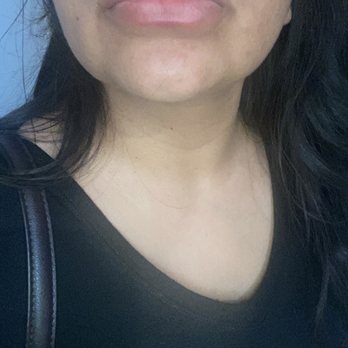 Plush Derma - Lip filler - Laser Hair Removal Near Me - El Monte, California Plush Derma - Lip filler - Laser Hair Removal Near Me - El Monte, California