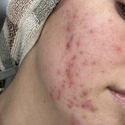 OC Esthetique and Spa - BEFORE coming to Hanan. Cystic acne. :(