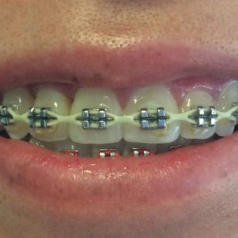 Henry Chung, DDS - After - General Dentistry Near Me - Los Angeles, California Henry Chung, DDS - After - General Dentistry Near Me - Los Angeles, California