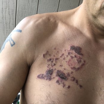 Hilo Laser Skincare - Thanks to Dr Miyashiro my tattoo is almost gone!   Can't wait for my skin to heal! - Tattoo Removal Near Me - Hilo, Hawaii