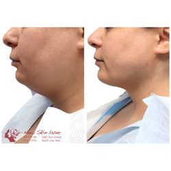 NewSkin Laser Center - Double Chin HD Liposuction