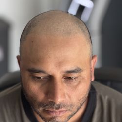 First session for him and he's already loving his smp results. I only aim for natural looking SMP results - Joe V. Nguyen