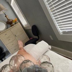 To the Point Acupuncture Center - Cupping on right hip and quad