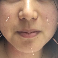 Yu' s Acupuncture