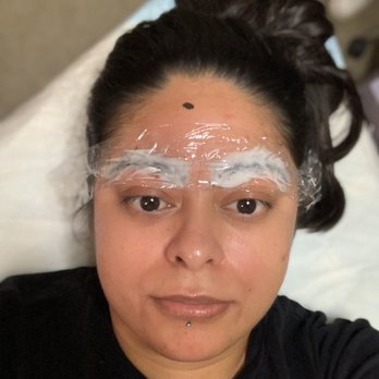 Miracullum Spa - Numbing on and working it's magic for 15 mins - Medical Spas Near Me - Walnut Creek, California